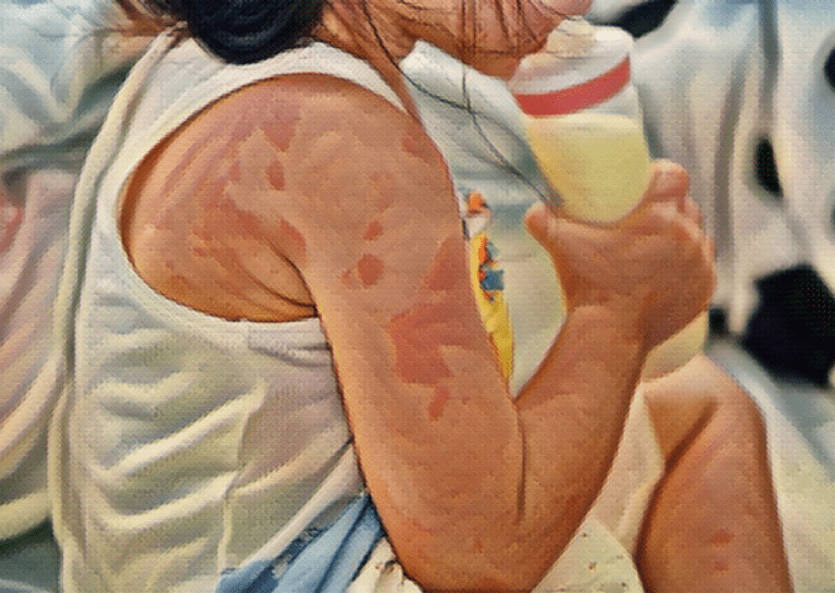 A child suffering milk allergies