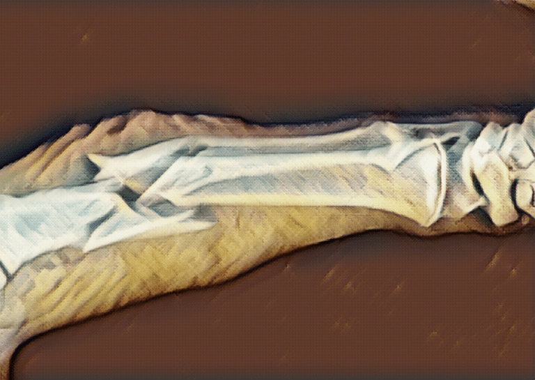 Illustration of Bone breakages or fractures