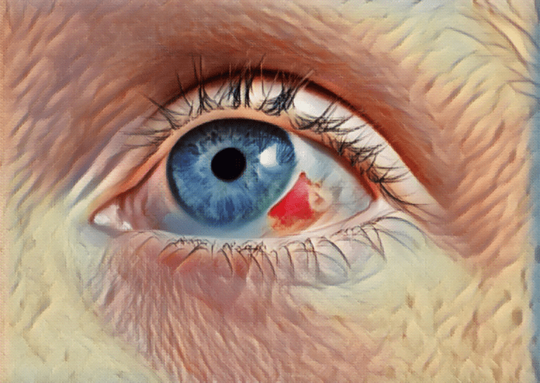 Eye Injury, Redness of an eye